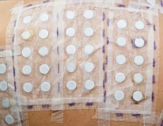 Patch Testing Rave About Skin patch-testing-rave-about-skin
